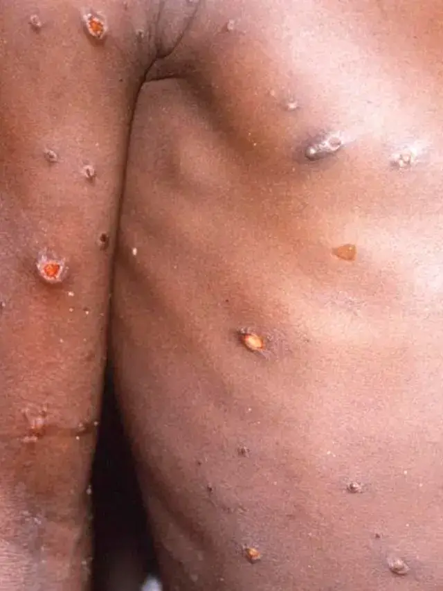 Monkeypox Symptoms Prevention Vaccines